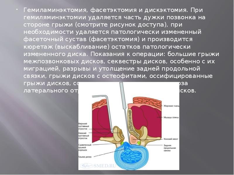 Гемиламинэктомия, фасетэктомия и дискэктомия. При гемиляминэктомии удаляется часть дужки позвонка на Гемиламинэктомия, фасетэктомия и дискэктомия. При гемиляминэктомии удаляется часть дужки позвонка на