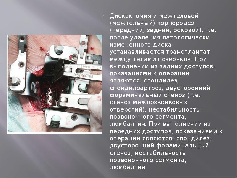 Дискэктомия и межтеловой (межтельный) корпородез (передний, задний, боковой), т.е. после удаления Дискэктомия и межтеловой (межтельный) корпородез (передний, задний, боковой), т.е. после удаления