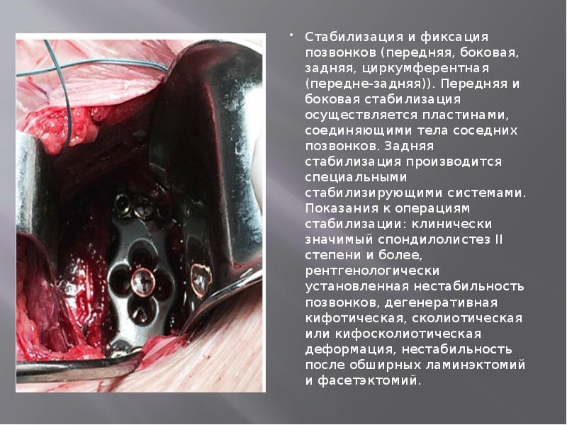 Стабилизация и фиксация позвонков (передняя, боковая, задняя, циркумферентная (передне-задняя)). Передняя и