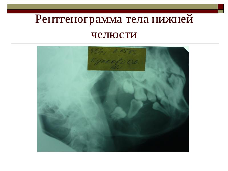 Рентгенограмма тела нижней челюсти Рентгенограмма тела нижней челюсти