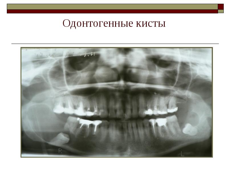 Одонтогенные кисты Одонтогенные кисты