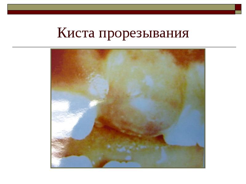 Киста прорезывания Киста прорезывания