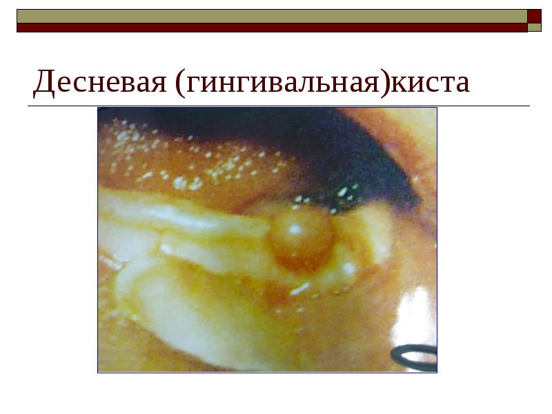 Десневая (гингивальная)киста Десневая (гингивальная)киста