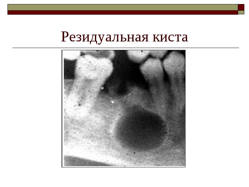 Резидуальная киста Резидуальная киста