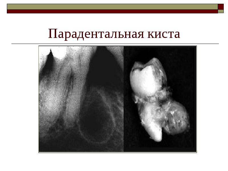 Парадентальная киста Парадентальная киста