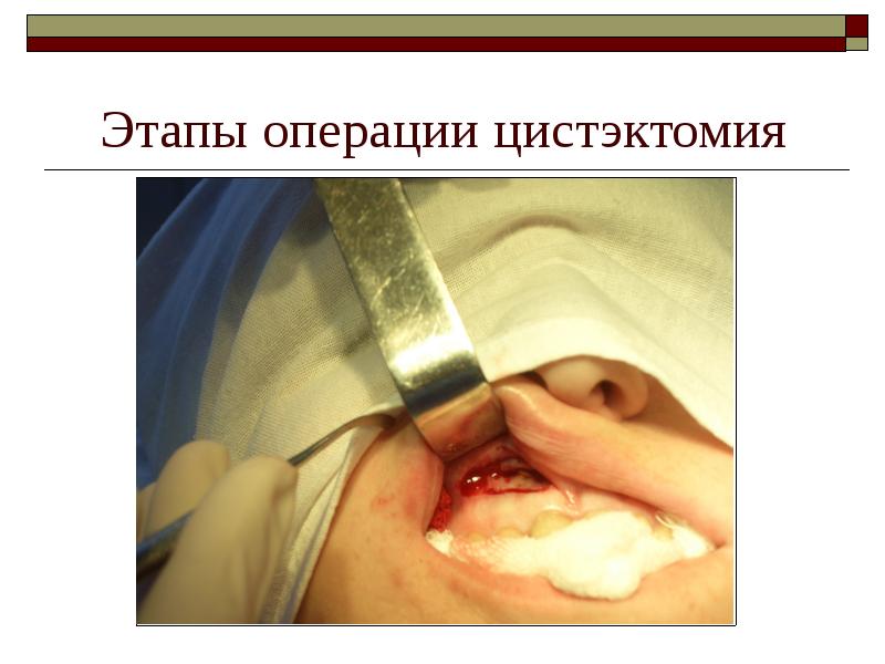 Этапы операции цистэктомия Этапы операции цистэктомия