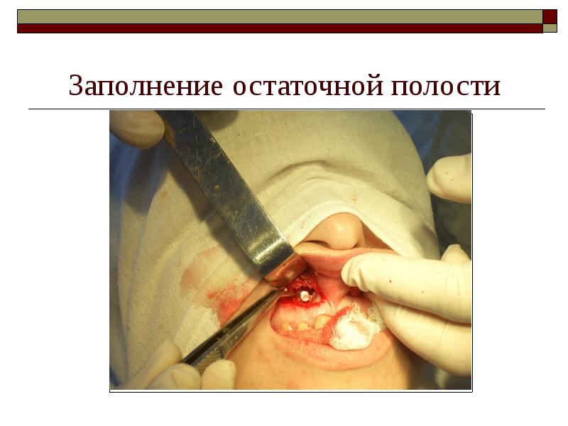 Заполнение остаточной полости Заполнение остаточной полости