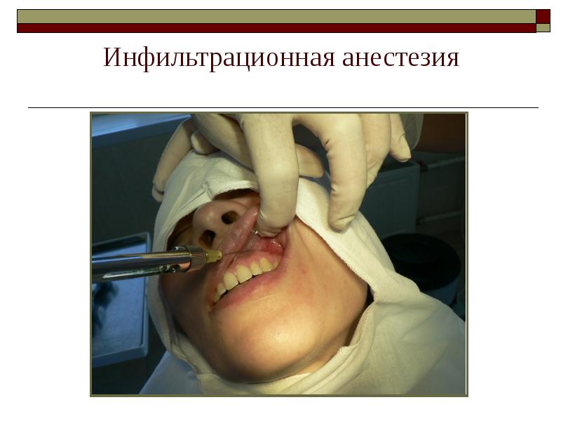 Инфильтрационная анестезия Инфильтрационная анестезия