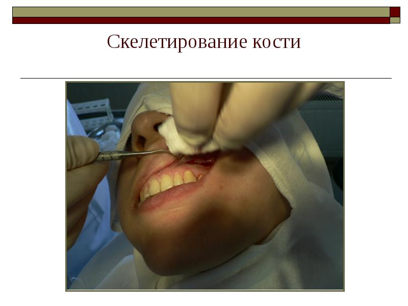 Скелетирование кости Скелетирование кости