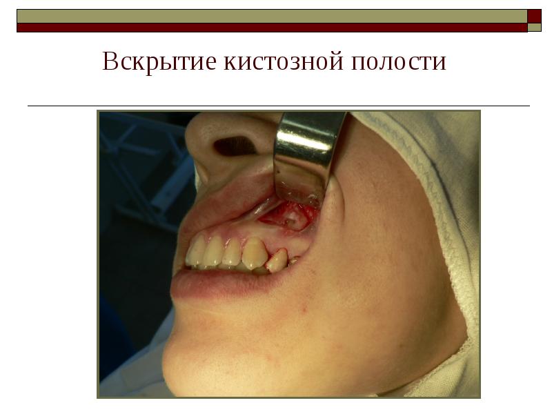 Вскрытие кистозной полости Вскрытие кистозной полости