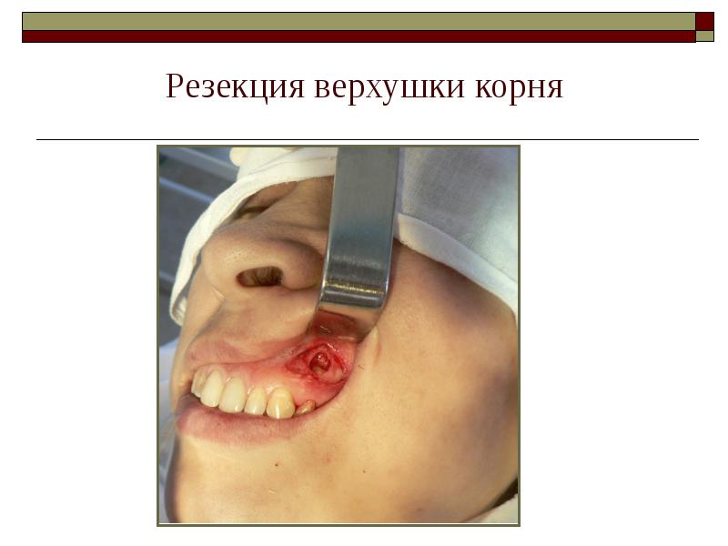 Резекция верхушки корня Резекция верхушки корня