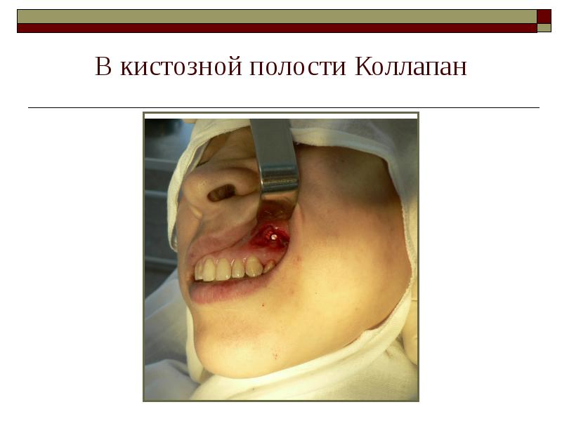 В кистозной полости Коллапан В кистозной полости Коллапан