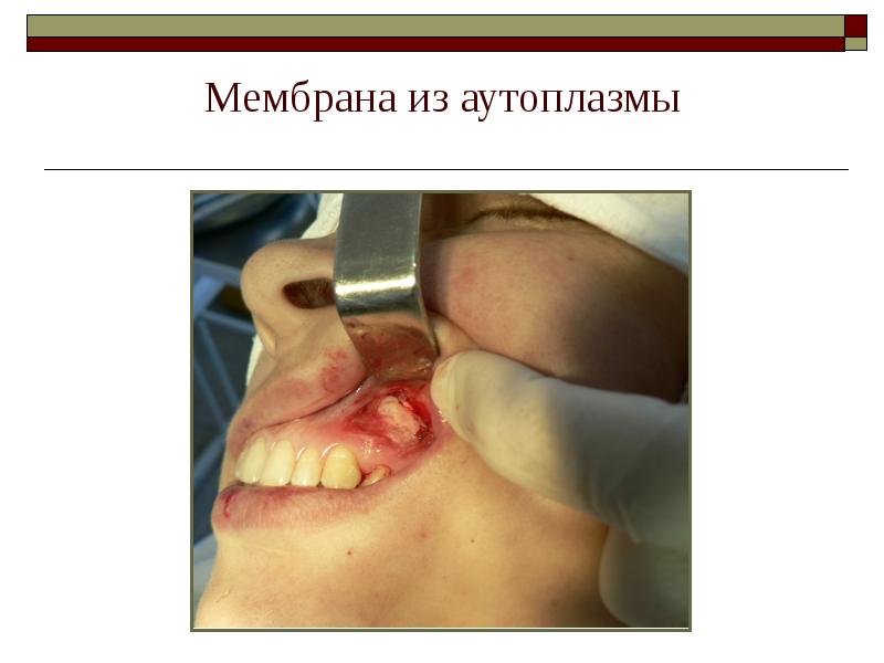 Мембрана из аутоплазмы Мембрана из аутоплазмы
