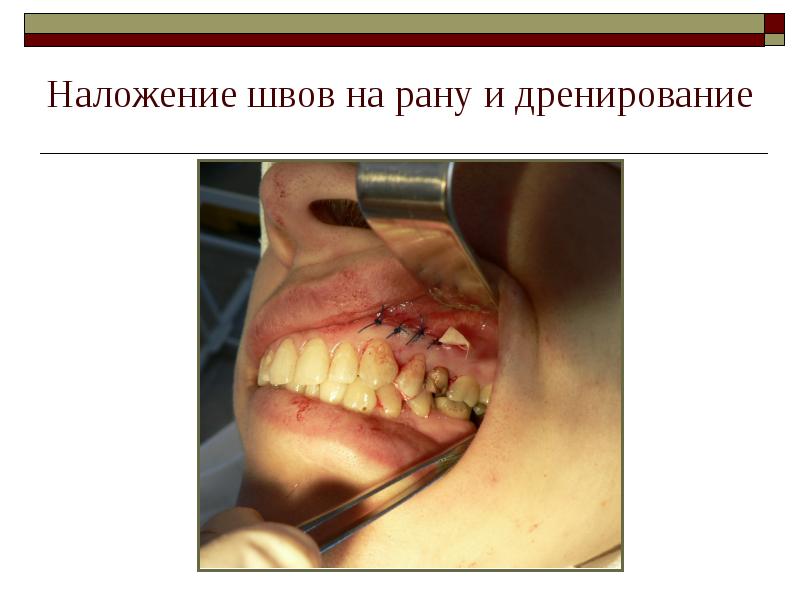 Наложение швов на рану и дренирование Наложение швов на рану и дренирование