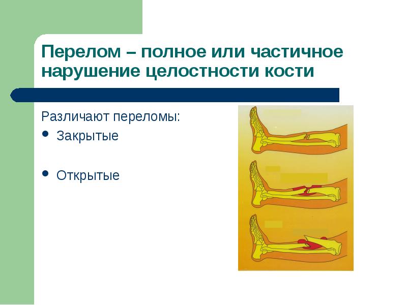 Презентация первая помощь при травмах опорно двигательной системы