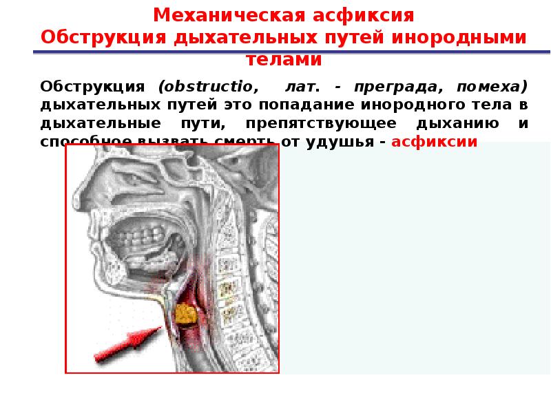 Попадание пищи. Непроходимость верхних дыхательных путей. Закупорка дыхательных путей инородным телом. Обструкция дыхательных путей. Обструкция верхних дыхательных путей.