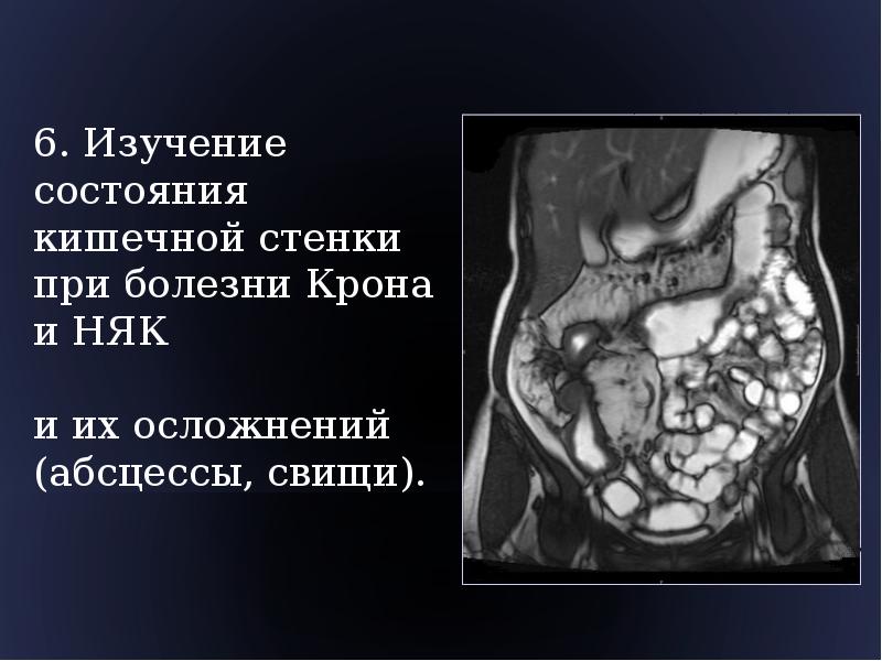 Энтерография. Болезнь крона мрт кишечника. Мрт энтерография болезнь крона. Кишечная непроходимость мрт.