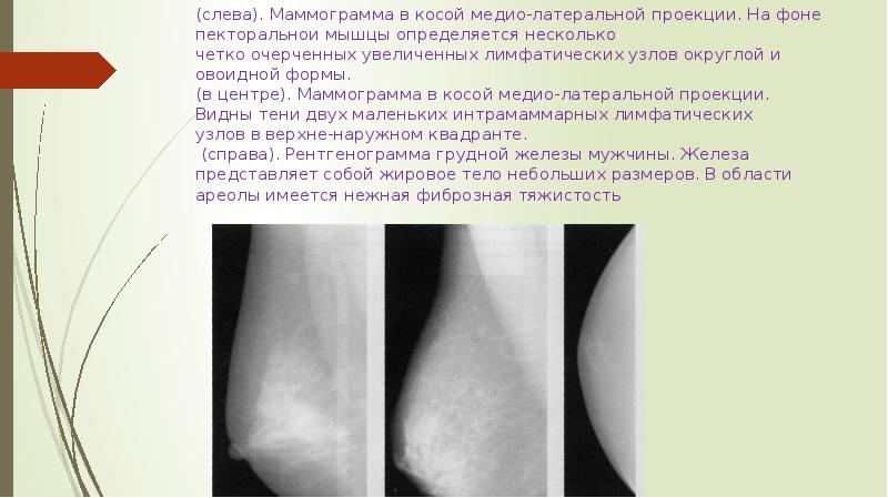 Что значит интрамаммарные лимфоузлы