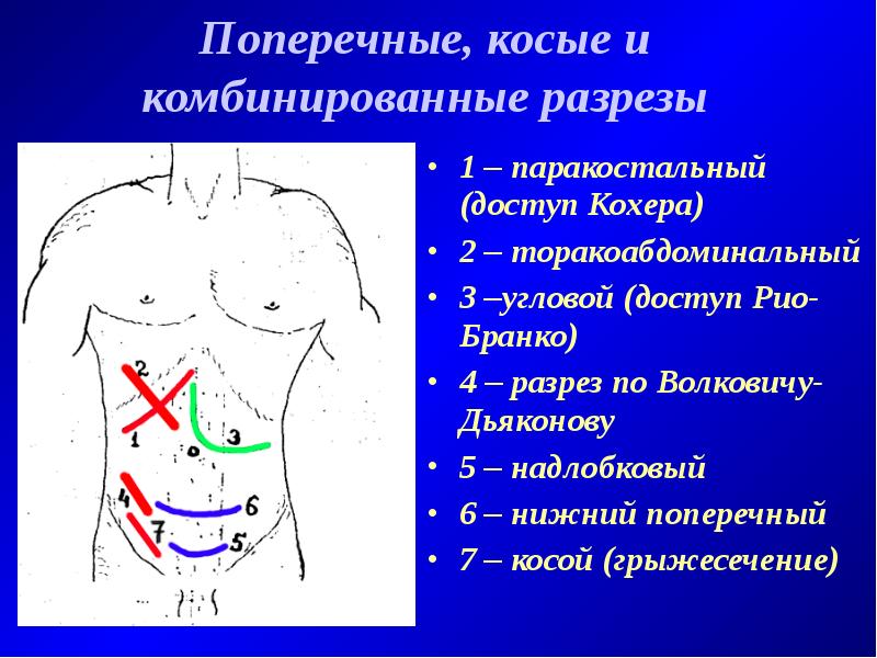 Операции брюшной. Оперативные доступы кохера Федорова. Схема оперативных доступов к органам брюшной полости. Оперативные доступы к органам верхнего отдела брюшной полости. Лапаротомия Рио Бранко.