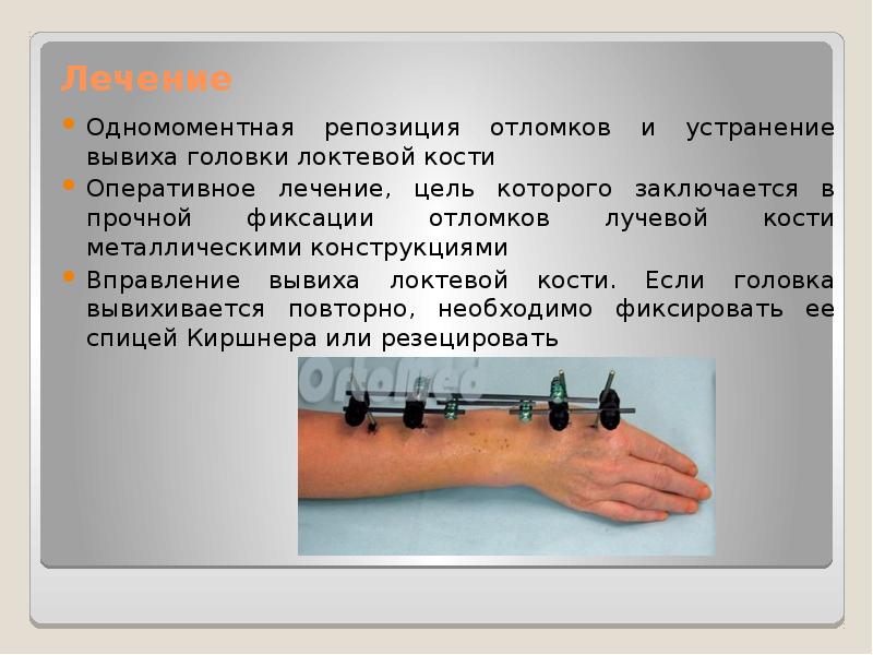 Перелом галеацци и монтеджи презентация