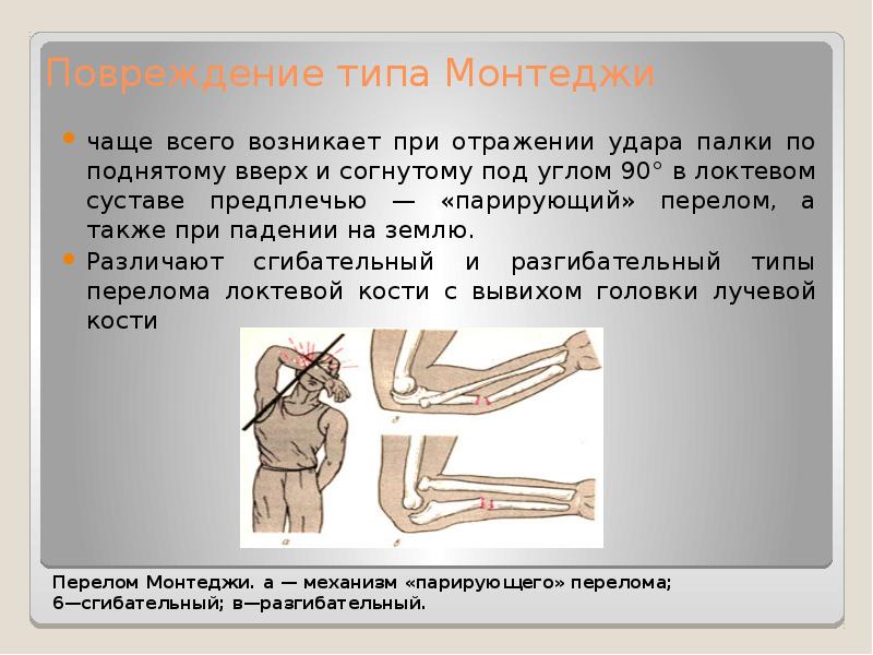 Перелом галеацци и монтеджи презентация