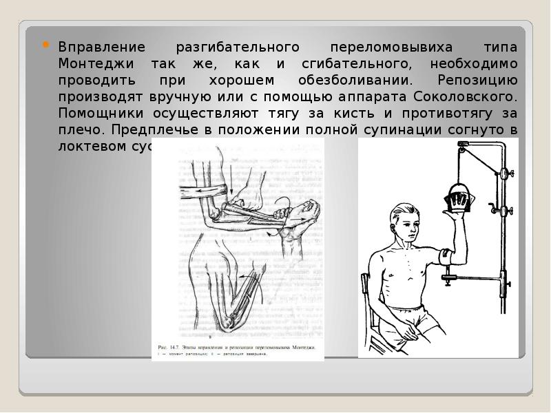 Презентация перелом монтеджи