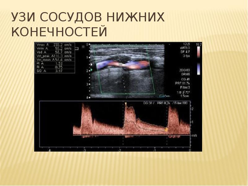 Узи вен нижних конечностей картинки