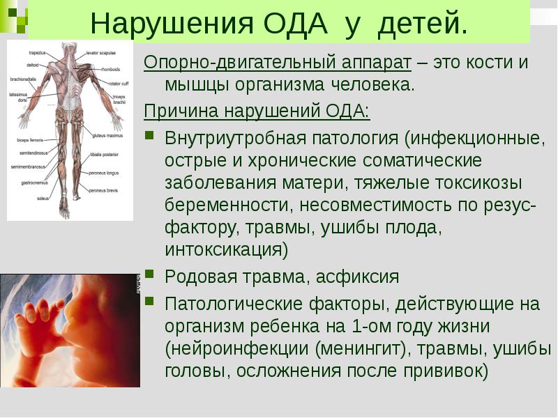 Пороки развития опорно двигательного аппарата презентация