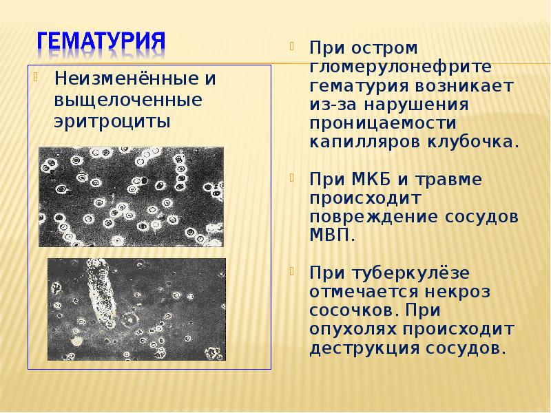 Неизмененные эритроциты в моче что это значит. Неизмененные эритроциты в моче что это значит