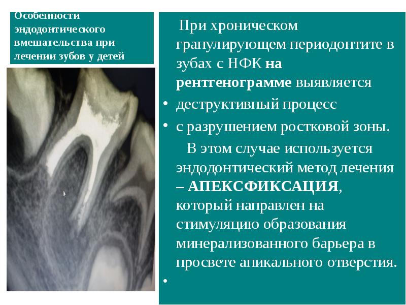 Острые формы пульпита презентация