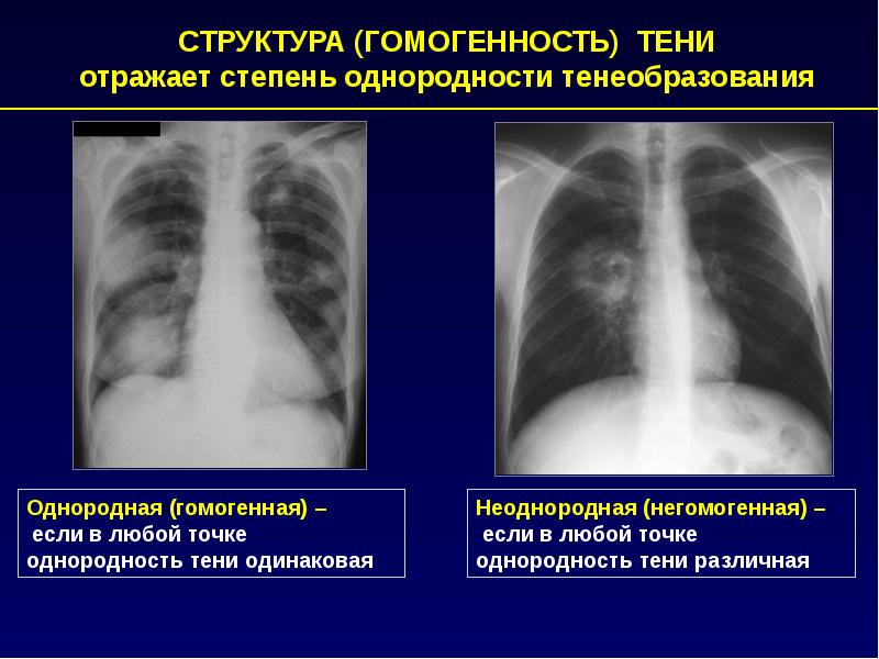 Тени средней интенсивности в легком