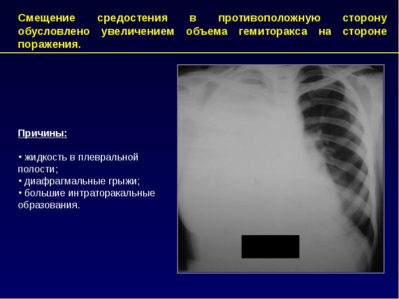 Пневмоторакс лучевая диагностика презентация