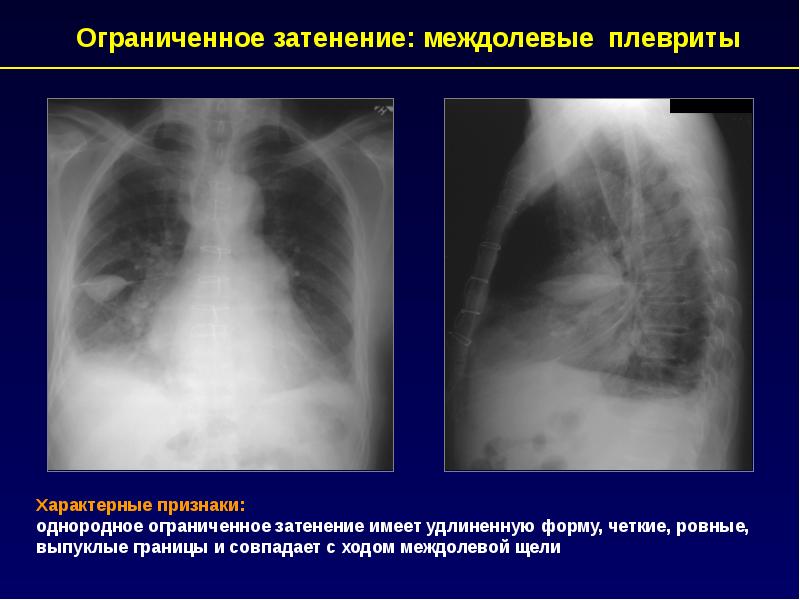 Признаки гидроторакса. Синдром ограниченного затенения. Гидроторакс рентген описание. Рентгенологические синдромы органов дыхания. Рентгенологические синдромы презентация.