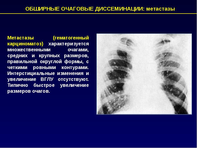 Метастазы в легких рентгенологическая картина