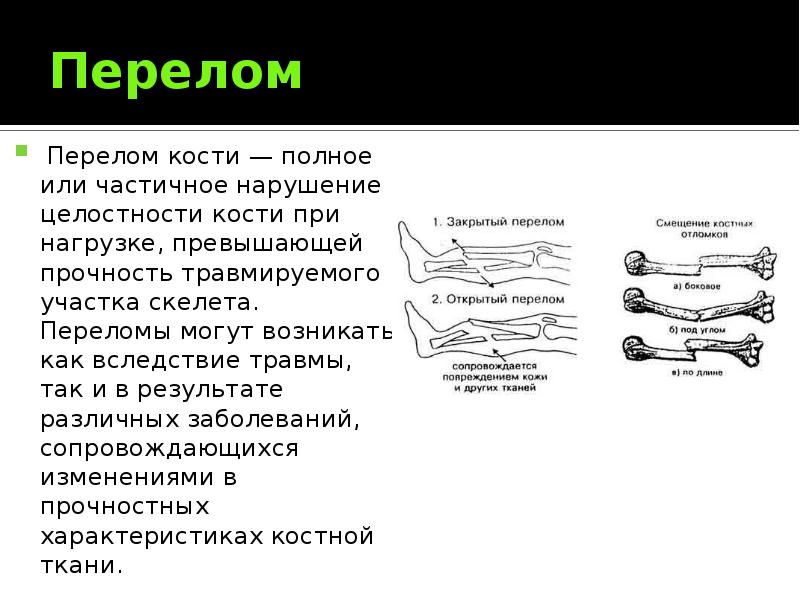 Перелом костей презентация