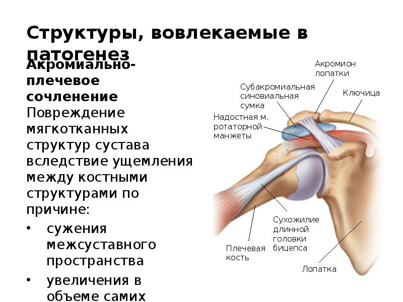 Боль в плечевом суставе правой руки. Плечелопаточный периартрит периартроз. Периартрит плечевого сустава синдром. Плечелопаточный периартрит симптомы. Периартрит плечевого сустава патогенез.