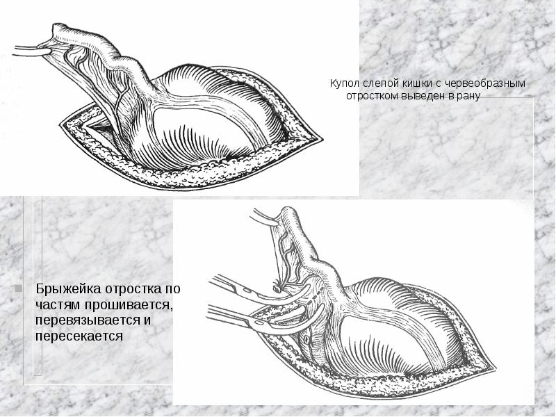 Купол слепой кишки где находится рисунок