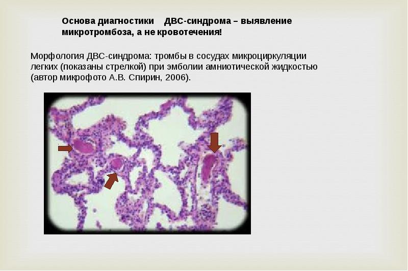 Двс синдром патофизиология презентация