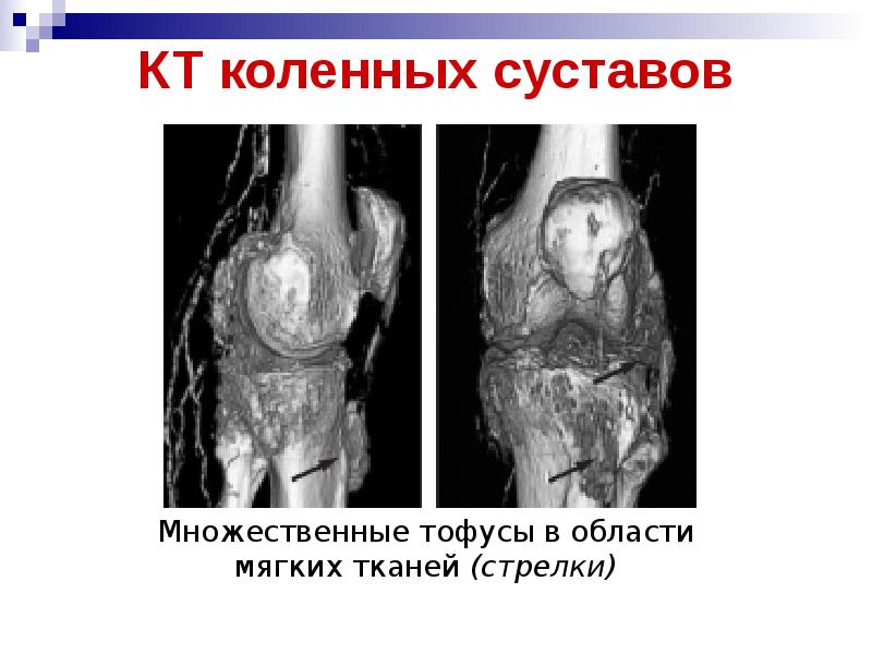 Презентации скачать бесплатно по подагре