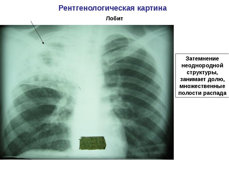 Туберкулез легких презентация