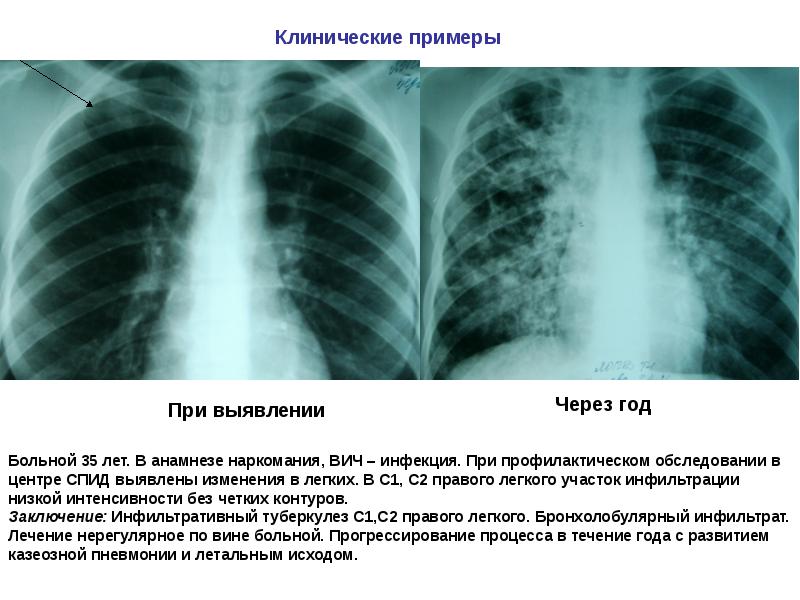 Туберкулез легких презентация