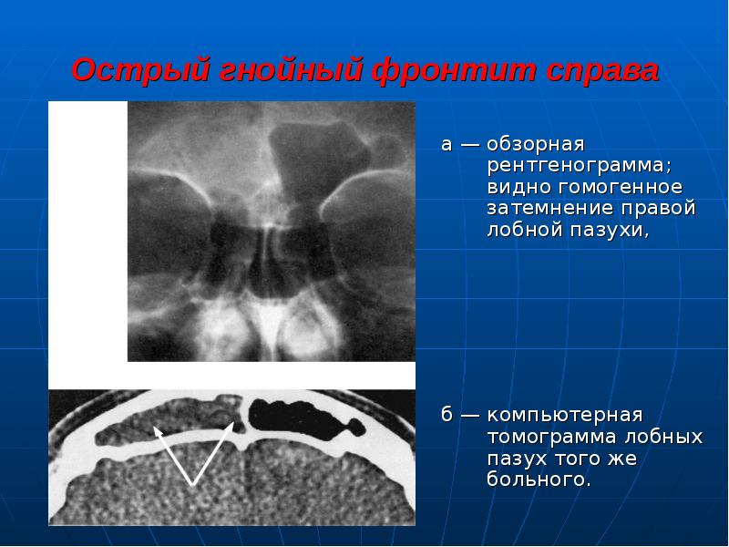 Острый синусит презентация