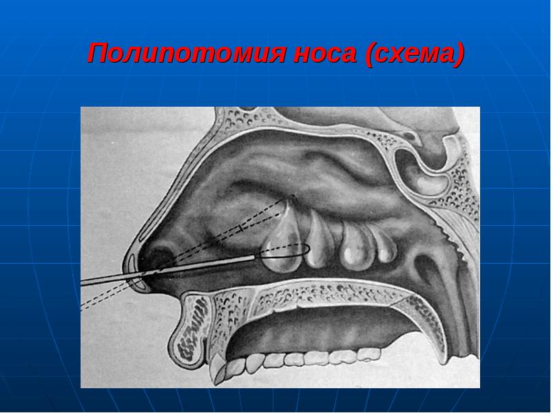 Острые и хронические синуситы презентация