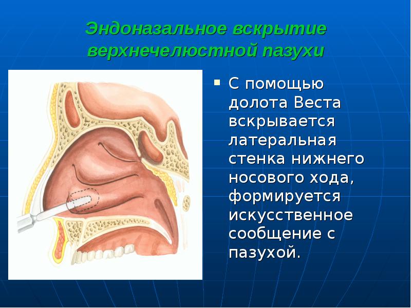 Риниты лор презентация