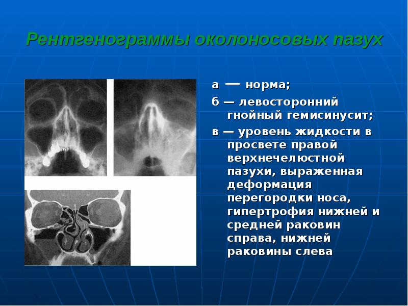 Острые и хронические синуситы презентация