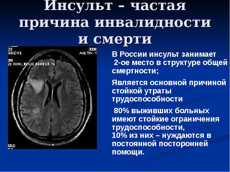 От инсульта умирают. Инсульт причина смерти. Частая причина инсульта. Ишемический инсульт смерть. Инсульт инвалидность.