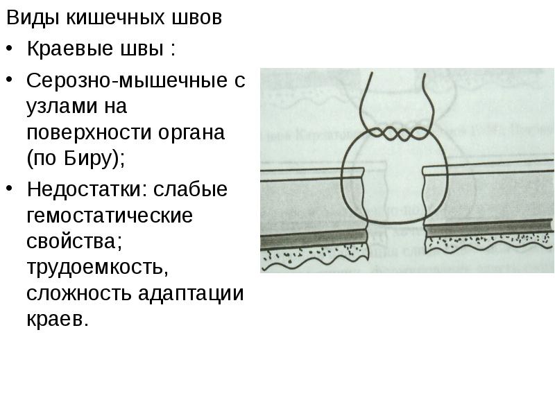 Кишечные швы топографическая анатомия презентация