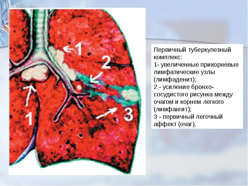 Первичный туберкулезный комплекс презентация