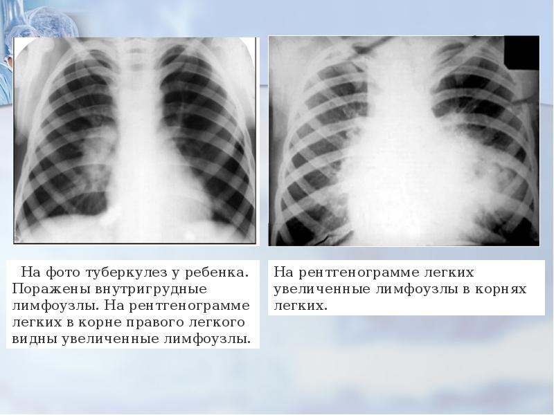 Туберкулезді лимфаденит презентация