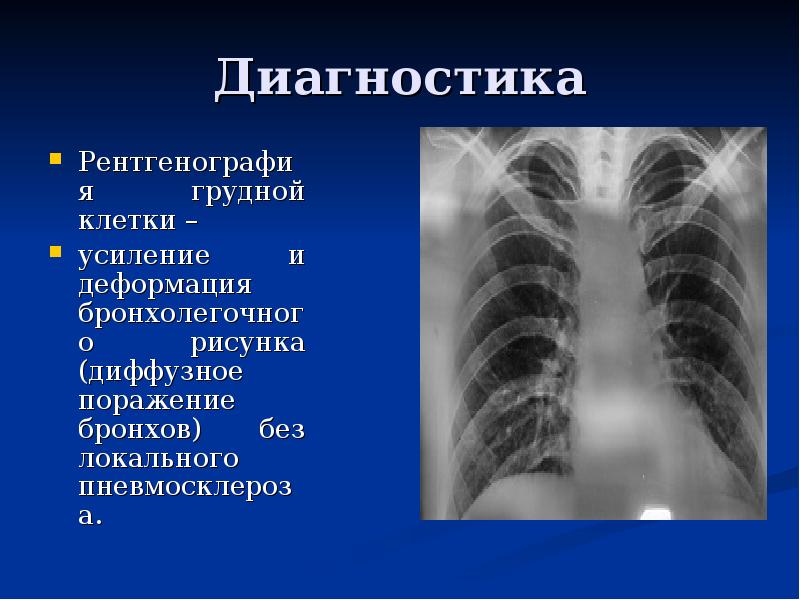 Что означает усиление легочного рисунка на рентгене у ребенка